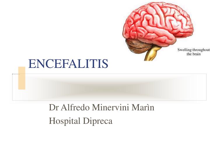 encefalitis
