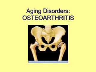 Aging Disorders: OSTEOARTHRITIS