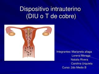 Dispositivo intrauterino (DIU o T de cobre)