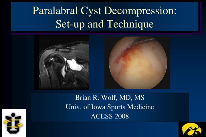 paralabral cyst decompression set up and technique