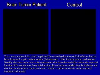 Brain Tumor Patient