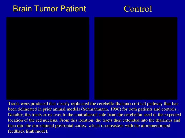 brain tumor patient