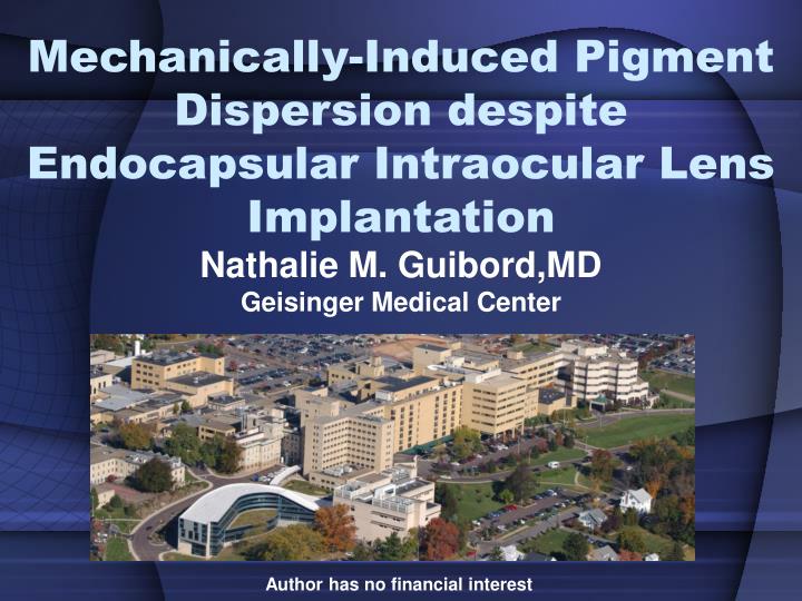 mechanically induced pigment dispersion despite endocapsular intraocular lens implantation