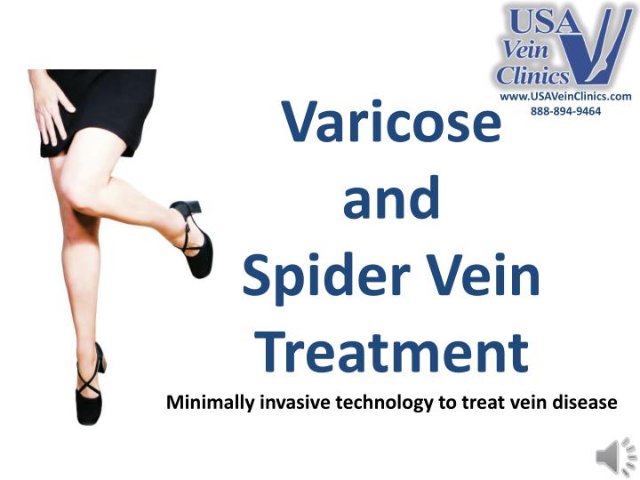 varicose and spider vein treatment minimally invasive technology to treat vein disease