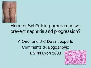 Henoch-Schönlein purpura:can we prevent nephritis and progression?