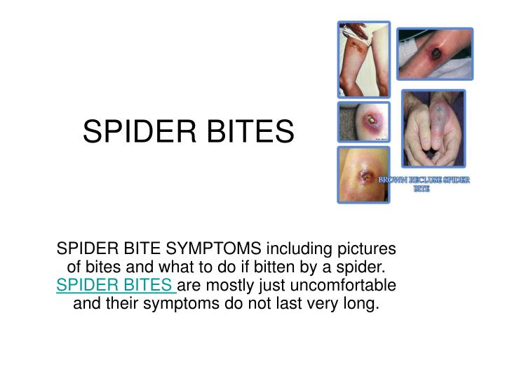 spider bites