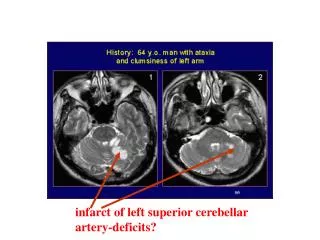 infarct of left superior cerebellar artery-deficits?