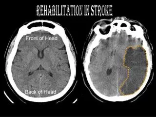 Rehabilitation in Stroke