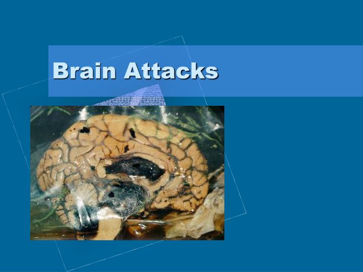 brain attacks