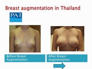 Breast Augmentation in Thailand | PAI