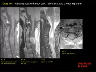 Case 10.1 : A young adult with neck pain, numbness, and a weak right arm.