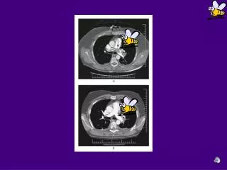 EMBOLIE PULMONAIRE SUBMASSIVE