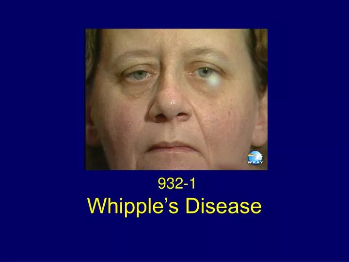 whipple s disease