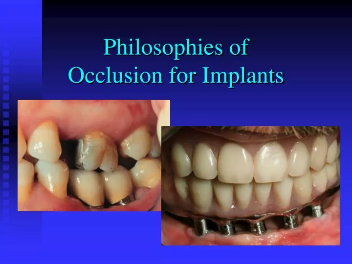 philosophies of occlusion for implants