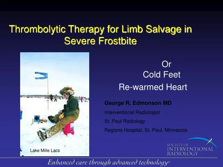 thrombolytic therapy for limb salvage in severe frostbite