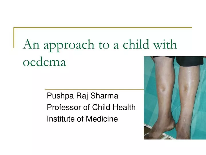an approach to a child with oedema