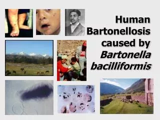 Human Bartonellosis caused by Bartonella bacilliformis