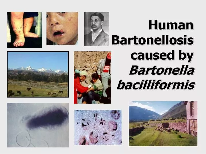 human bartonellosis caused by bartonella bacilliformis