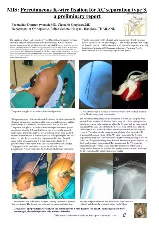MIS: Percutaneous K-wire fixation for AC separation type 3, a prelim i nary report