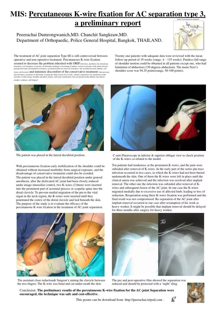 mis percutaneous k wire fixation for ac separation type 3 a prelim i nary report