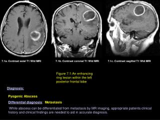 7.1a. Contrast axial T1 Wtd MRI