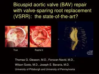 Bicuspid aortic valve (BAV) repair with valve-sparing root replacement (VSRR): the state-of-the-art?