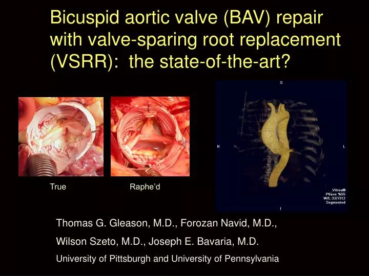 bicuspid aortic valve bav repair with valve sparing root replacement vsrr the state of the art