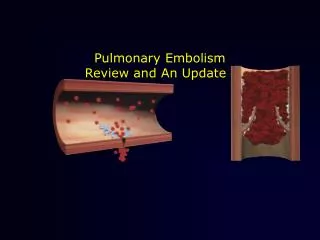 Pulmonary Embolism Review and An Update
