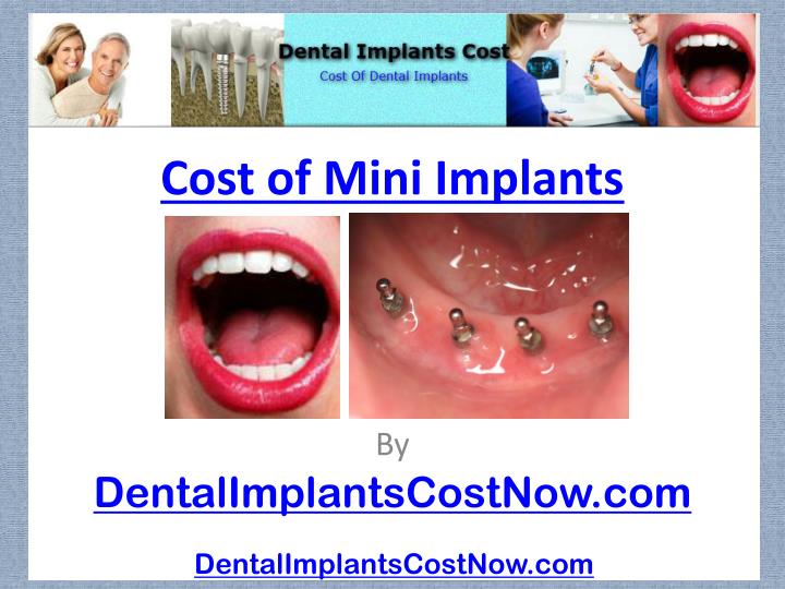 cost of mini implants