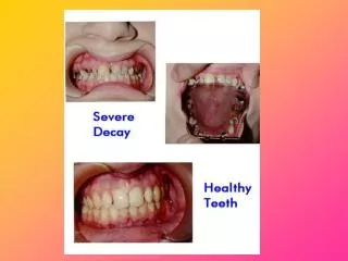 Periodontal/Gum Disease