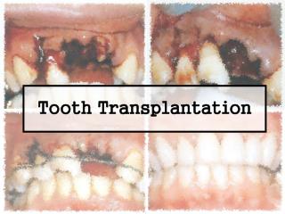 Tooth Transplantation