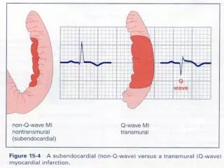 ECG Changes in Acute Myocardial Infarction