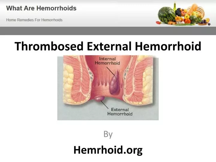 thrombosed external hemorrhoid