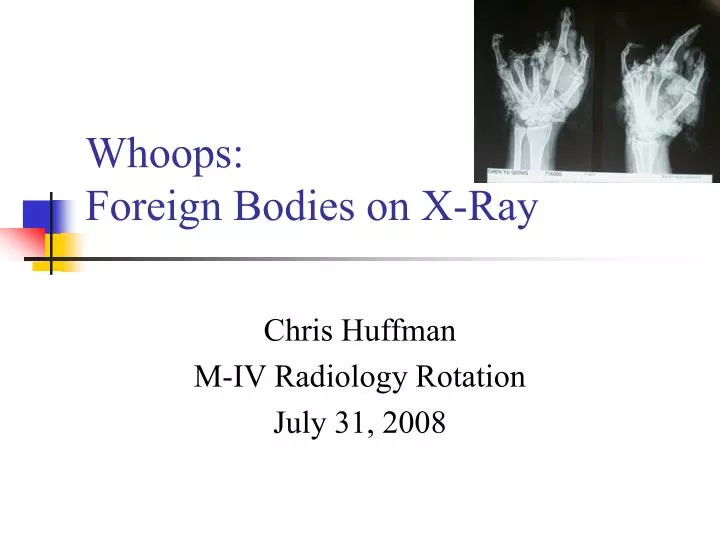 whoops foreign bodies on x ray