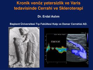 Kronik venöz yetersizlik ve Varis tedavisinde Cerrahi ve Skleroterapi Dr. Erdal Aslım Ba ş kent Üniversitesi T ı p Fakü