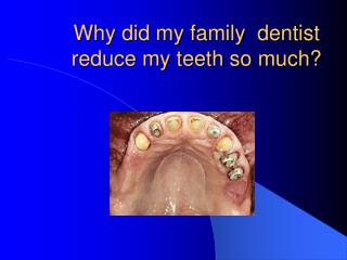 Why did my family dentist reduce my teeth so much?