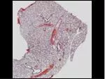 COPD (chronic obstructive pulmonary disease) - slide 1