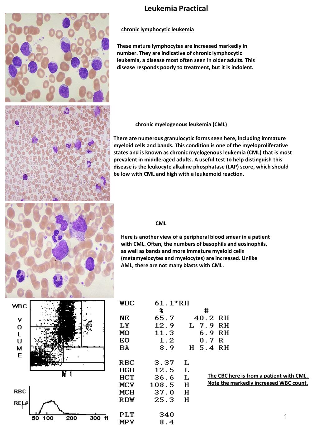 PPT - chronic lymphocytic leukemia PowerPoint Presentation, free ...