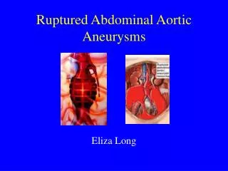 Ruptured Abdominal Aortic Aneurysms