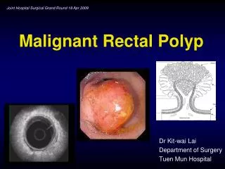 Malignant Rectal Polyp