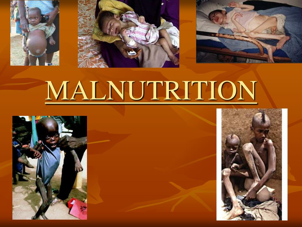 PPT - MALNUTRITION PowerPoint Presentation, free download - ID:432735