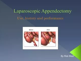 Laparoscopic Appendectomy