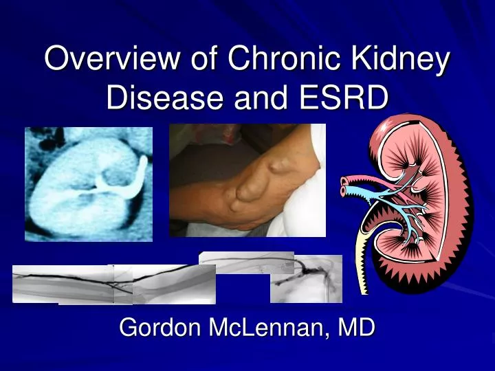 overview of chronic kidney disease and esrd