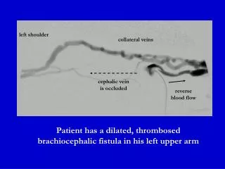 Patient has a dilated, thrombosed brachiocephalic fistula in his left upper arm