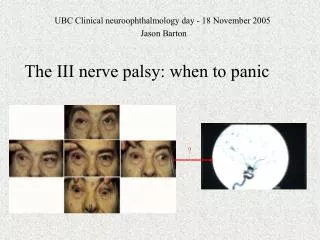 The III nerve palsy: when to panic