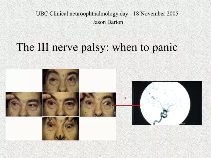 the iii nerve palsy when to panic