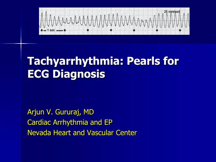 tachyarrhythmia pearls for ecg diagnosis