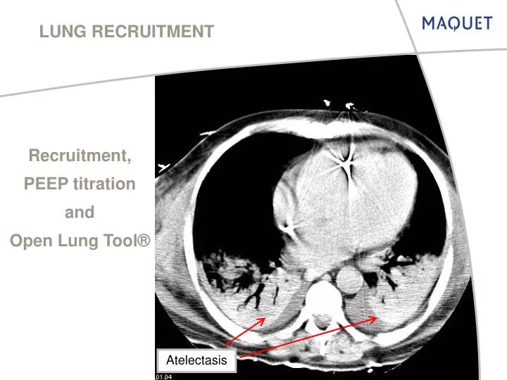 lung recruitment