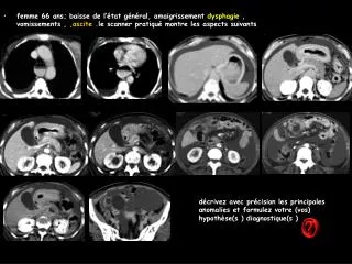 femme 66 ans; baisse de l’état général, amaigrissement dysphagie , vomissements , ,ascite .le scanner pratiqué montr