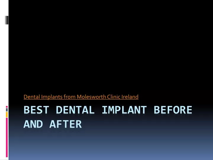 dental implants from molesworth c linic ireland